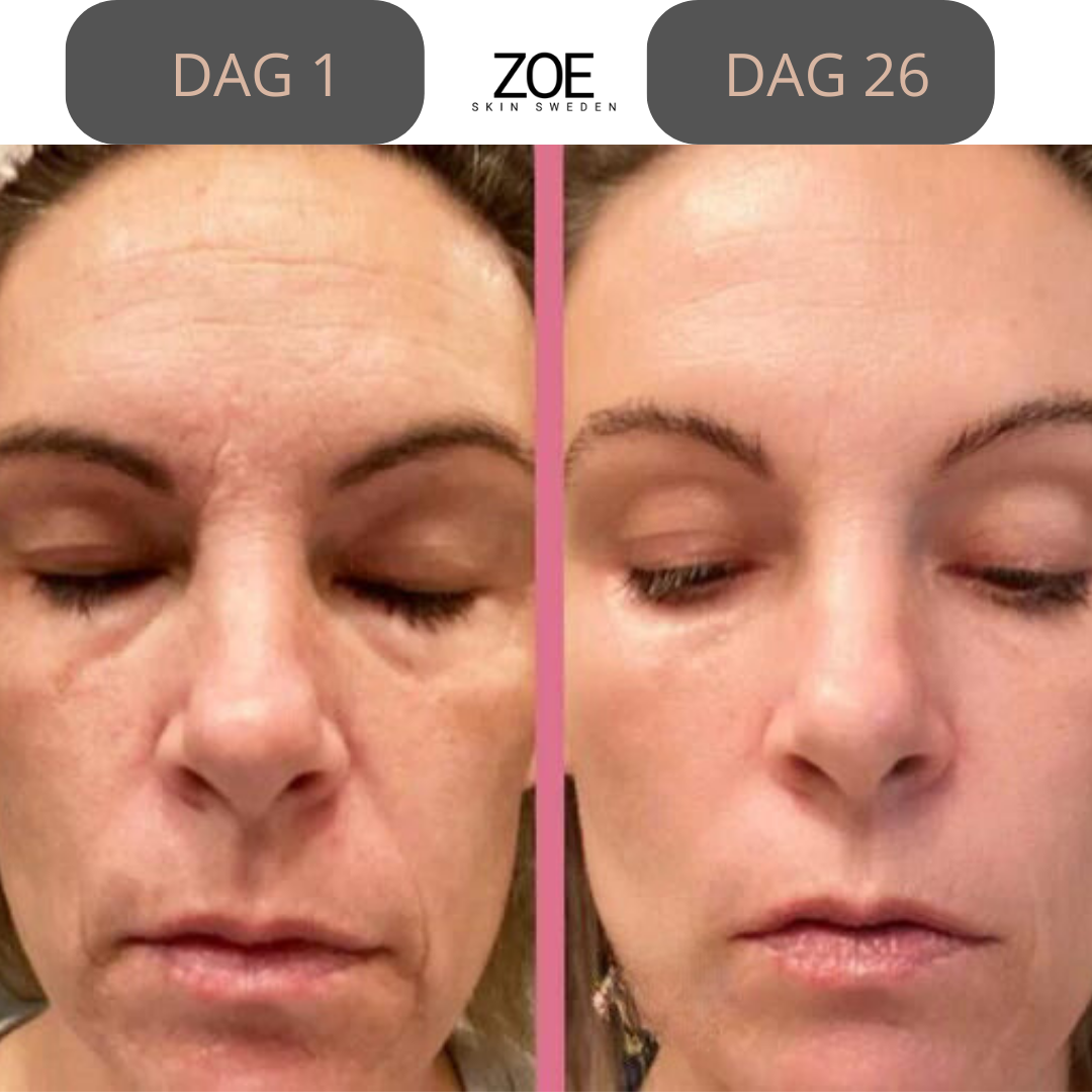 Zoe- Face Lifting