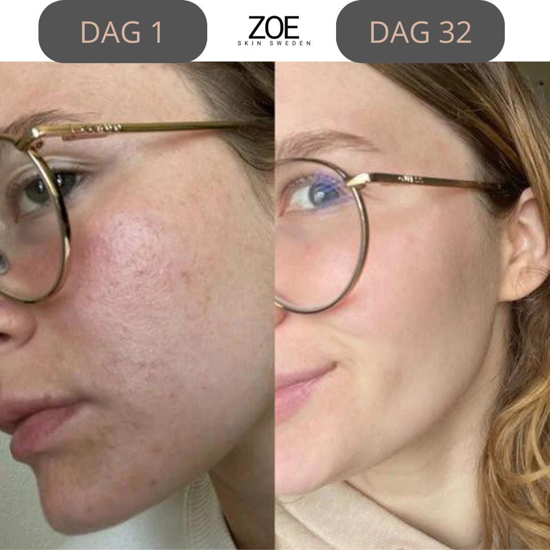 Zoe- Face Lifting