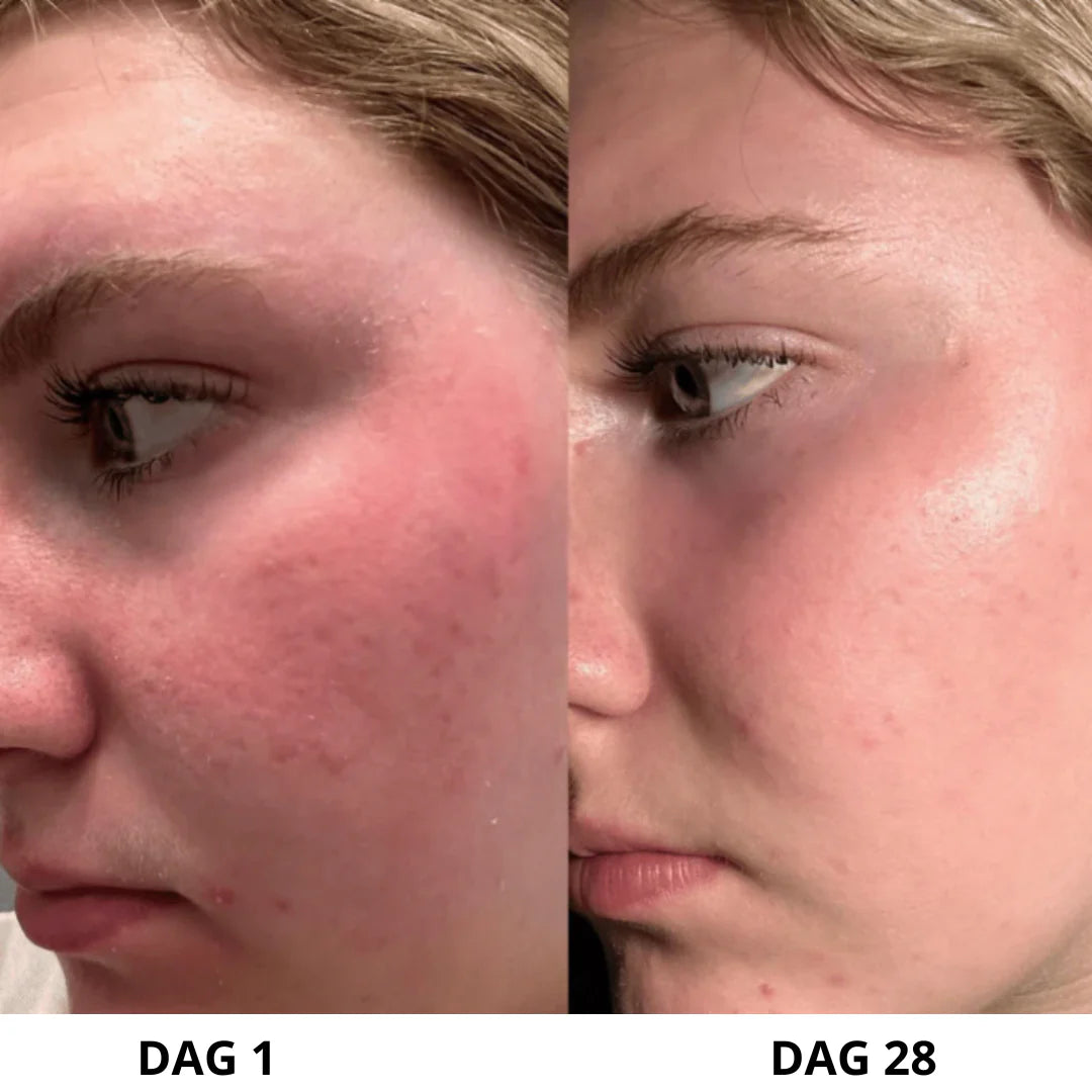 Exfoliante ultrasónico para la piel