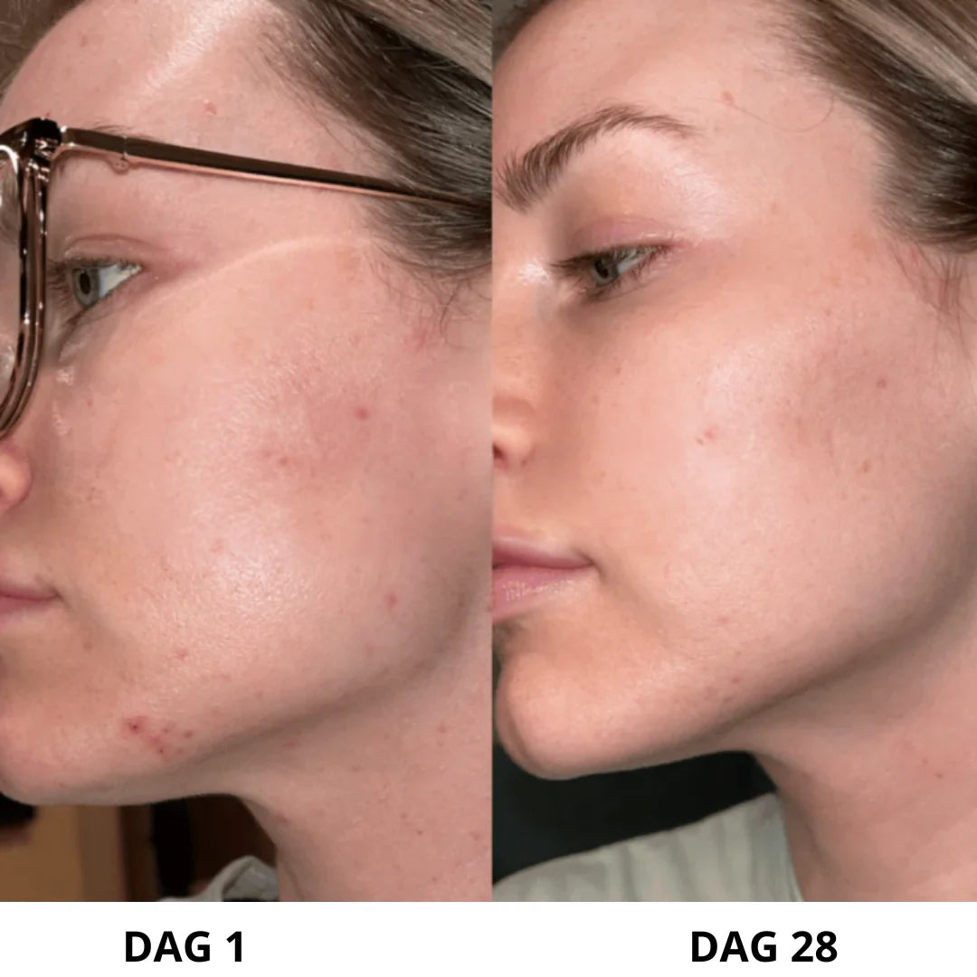Exfoliante ultrasónico para la piel