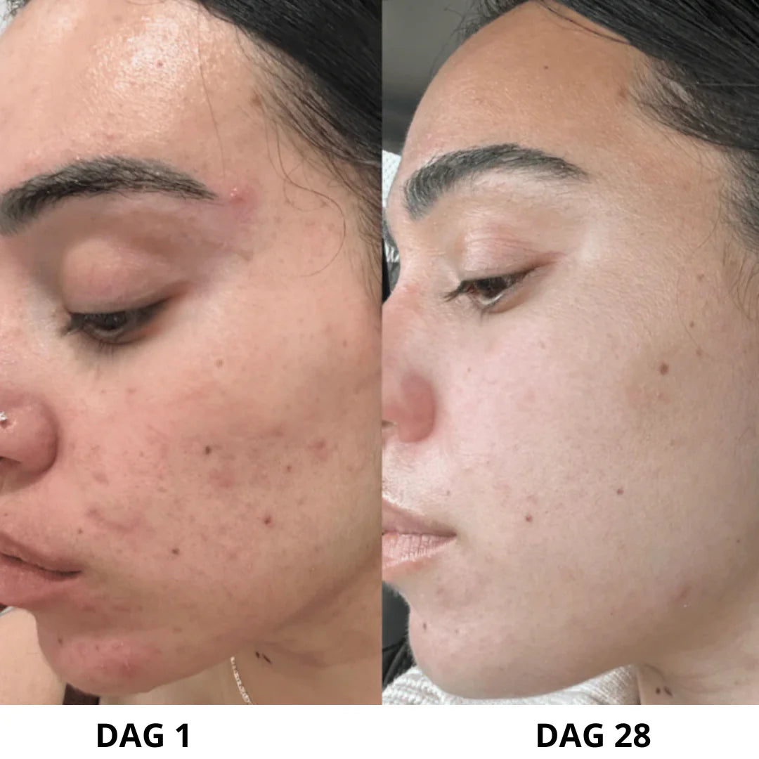 Exfoliante ultrasónico para la piel