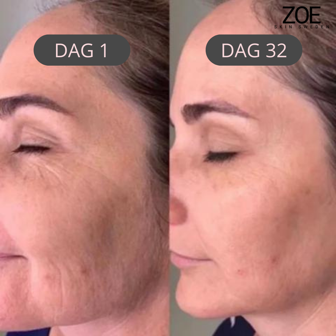 Zoe- Face Lifting
