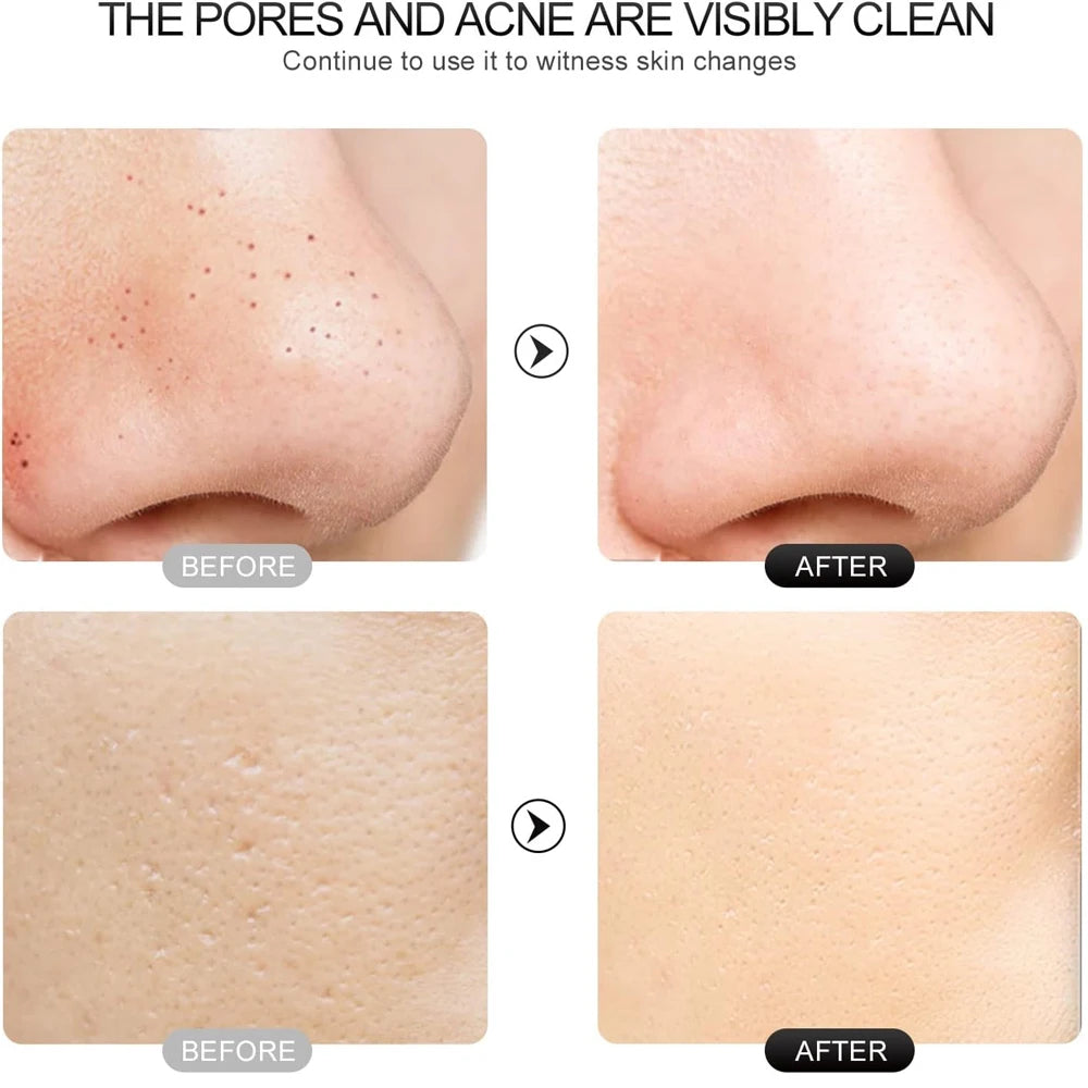 Exfoliante ultrasónico para la piel