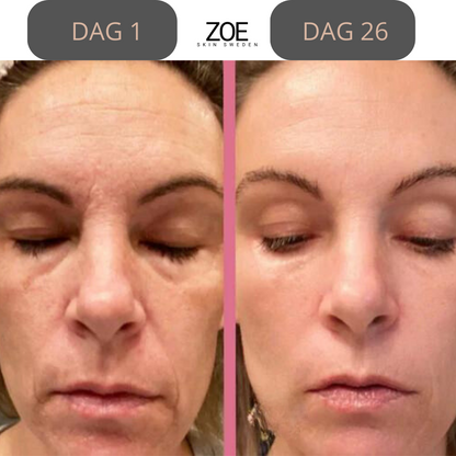 Zoe- Face Lift