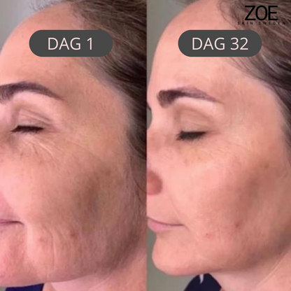 Zoe-  Face Lifting